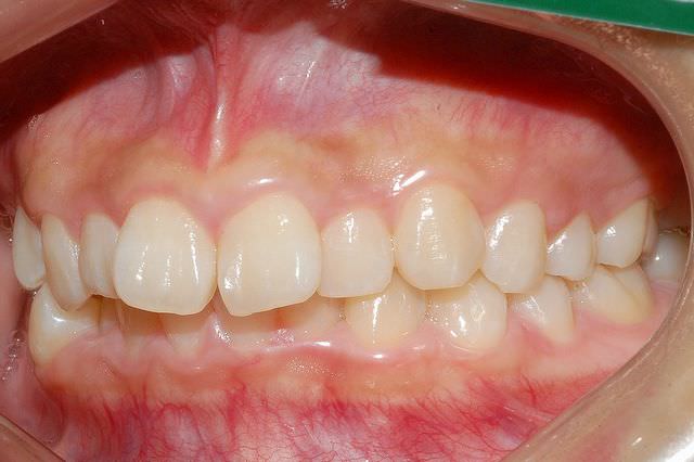 上顎前突 治療前