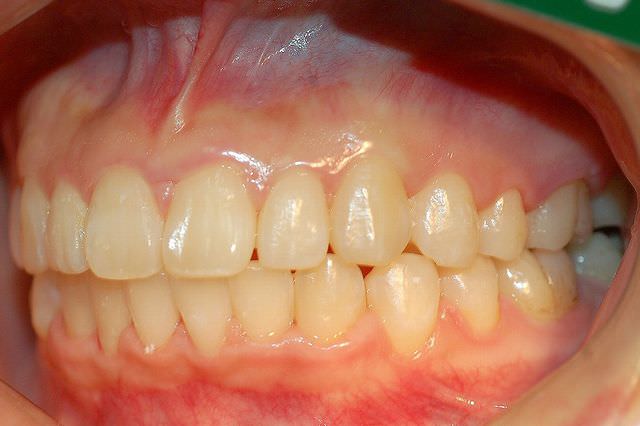 上顎前突 治療後