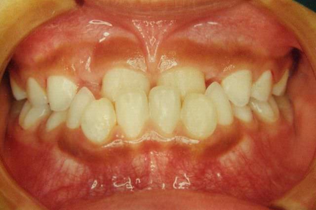 下顎前突 治療前