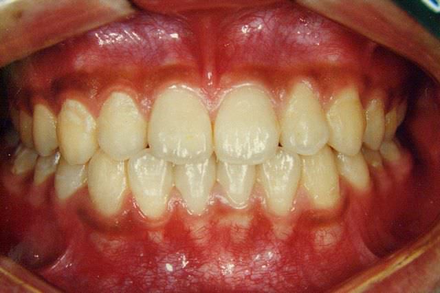 下顎前突 治療後