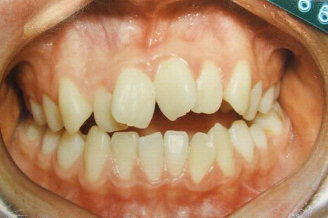 開咬 治療前
