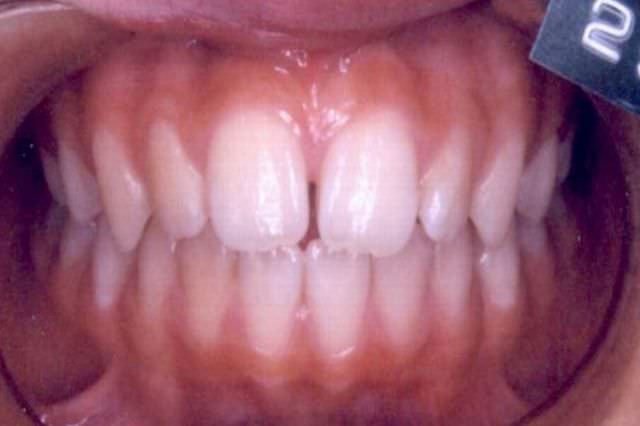 正中離開 治療前