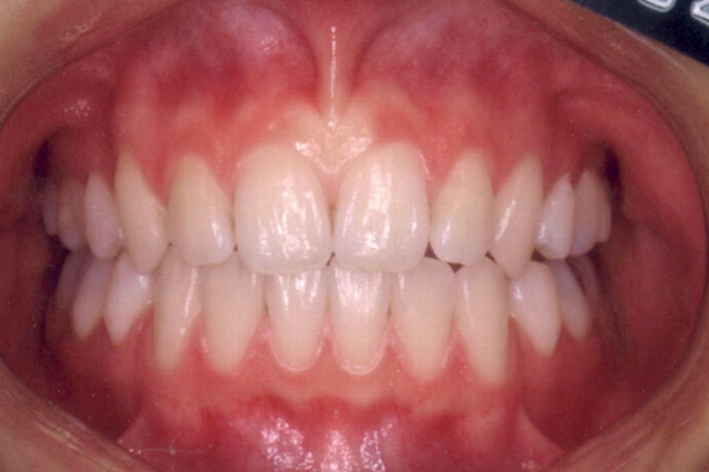 正中離開 治療後